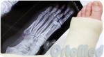 Перелом 5 плюсневой кости с допустимым смещением фото 1