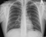 Расшифровка рентгенографии, кашель, боль в легком фото 1