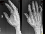 Перелом пальца руки фото 2