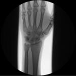 Перелом руки, расшифровка рентгена фото 1