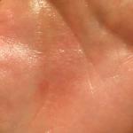 Сыпь на левой ладони руки маленькие пупырыжки под кожей фото 1