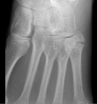 Трещина или перелом плюсневой кости фото 3