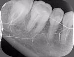 Онемение губы и подбородка после лечения зуба фото 1