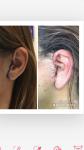 Искажение и онемение уха после подтяжки лица фото 1