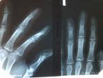 Последствия открытого перелома 4 пальца левой кисти фото 5