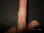 Травма пальца руки фото 3