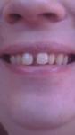 Диастемма между передними зубами фото 1
