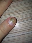 Грибок ногтя большого пальца на руке фото 1