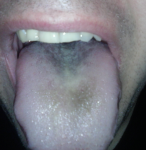 После лечения зубов у языка нарушилась чувствительность фото 1