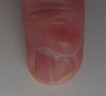 Деформация ногтя, (папиллома?) фото 1