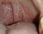 Опухоль на дужке миндпалины в горле фото 1