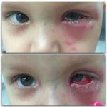 Стрептодермия у ребенка, вирусный конъюнктивит фото 1