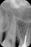 Болит зуб со штифтом при накусывании фото 1