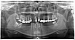 Обтачивание зубов при повторном протезировании фото 1