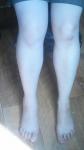 Отек голеностопа при травме коленного сустава фото 3