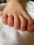 Утолщенные, слоистые ногти у ребенка фото 1