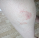Красное пятно на ноге 3 месяца (после антибиотиков) фото 1