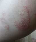 Красное пятно на ноге 3 месяца (после антибиотиков) фото 2