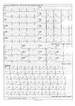 Помогите расшифровать ЭКГ, консультация кардиолога онлайн фото 1