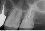 Боль в зубе под коронкой фото 2