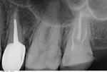 Боль в зубе под коронкой фото 1