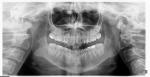 Болит нёбо и передние верхние зубы фото 1