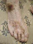 Результат лечения красных пятен на ногах фото 2