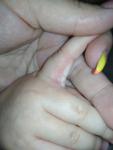 Сыпь между пальчиками на руке фото 1