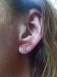 Болячки или язвы образовались на ухе и распространяются по телу фото 1