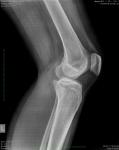 Боль в колене мрт и рентген фото 2