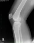 Боль в колене мрт и рентген фото 3