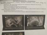 Параовариальная киста или внематочная беременность фото 1