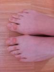 Натертости на пальцах ног фото 1