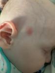 Красные пятна на лице у ребенка 11 месяцев фото 1