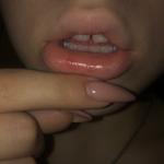 Красные пятна на слизистой губы фото 3