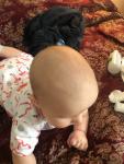 Ассиметричная черепа у ребёнка в 5 месяцев фото 2