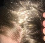 Псориаз волосистости части головы фото 1
