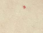 Мелкие кровяные точки на груди фото 2