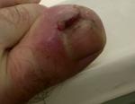 Гноящаяся рана на пальце ноги фото 2