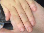 Поражённые ногти фото 2