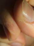 Отслоение и воспаление кожи вокруг ногтей несколько месяцев фото 1