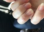 Трещины на пальцах и кожный зуд фото 1