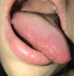 Болит язык, бугорки фото 2