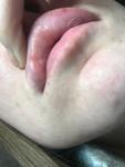 Водянистый бугорок на слизистой верхней губы фото 1