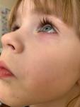 Воспаление глаза у ребёнка 4 лет фото 3