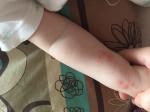 Сыпь на руках у ребёнка большие прыщи фото 2