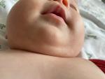 Высыпание на лице и теле у ребёнка 4 месяцев фото 1