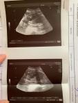 Расширение петли кишечника, узи, беременность, третий триместр фото 2