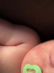 Акне новорождённого или аллергия? фото 2