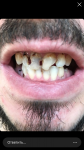Ужасное состояние зубов, кариес на передних зубах, протезирование нужно фото 1